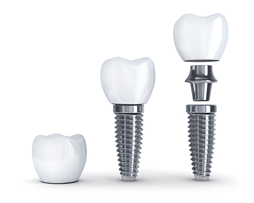 Dental Implants Pieces Diagram iStock 000077095183 Large width of 500 pixels